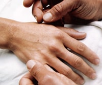 Acupuncture treatment