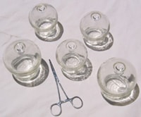 Cupping treatment