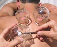 Cupping treatment