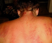 Gua Sha treatment